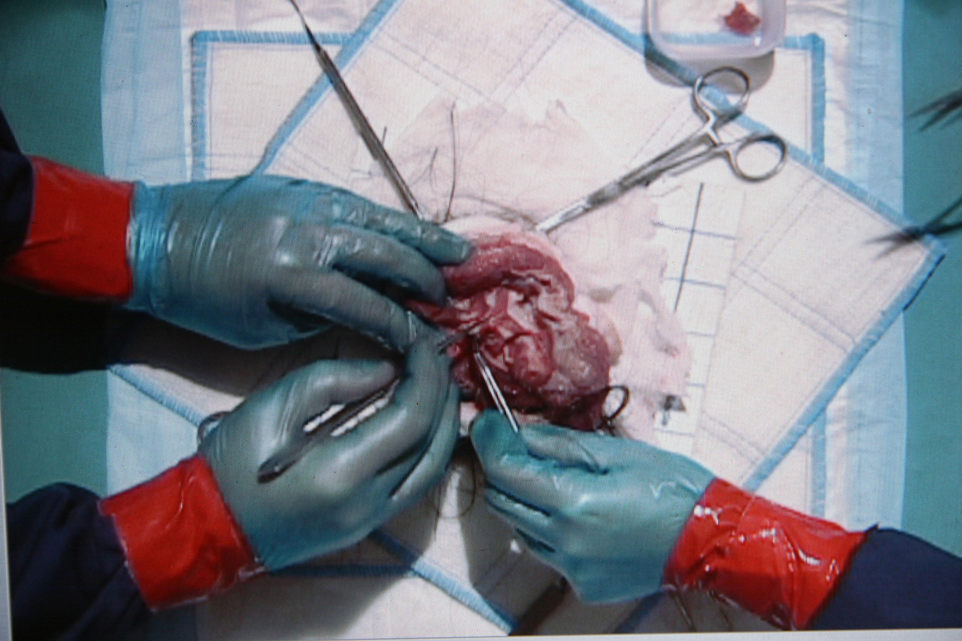 ovarian teratoma histology stain